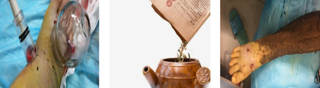 【1000余例蛇咬伤】泸州男子用嘴吸蛇毒,夫妻俩人差点……(图4) 4.jpg