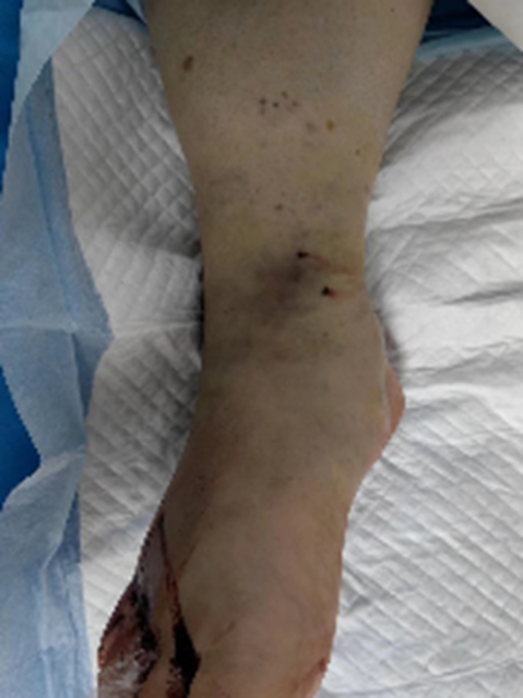 【1000余例蛇咬伤】泸州男子用嘴吸蛇毒,夫妻俩人差点……(图2) 2.jpg