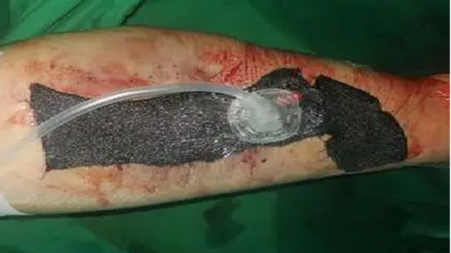 【1000余例蛇咬伤】泸州男子用嘴吸蛇毒,夫妻俩人差点……(图6) 6.jpg