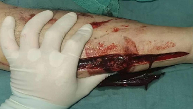 【1000余例蛇咬伤】泸州男子用嘴吸蛇毒,夫妻俩人差点……(图5) 5.jpg