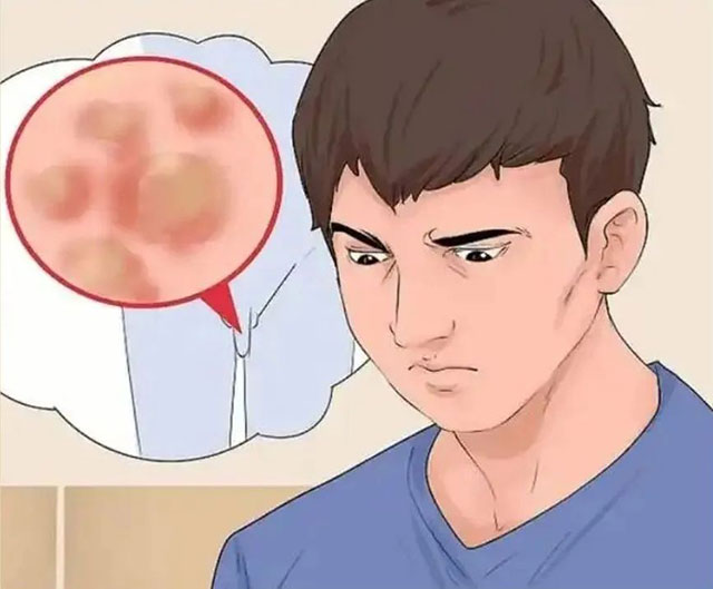 【围观】男子感染HPV拖15年,“命根子”被切4公分!(图3) 3.jpg