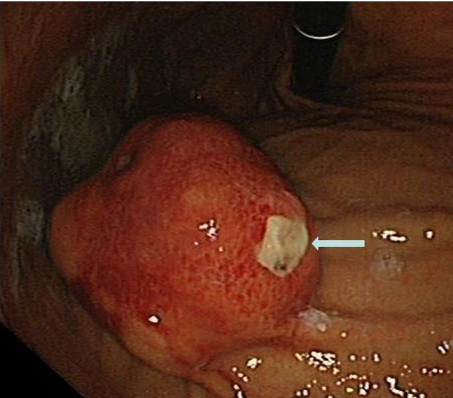 “饿死”大肿瘤、巧手建“隧道”,双微创技术牛!(图1) 1.jpg