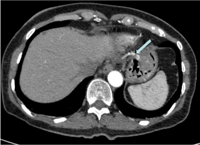 “饿死”大肿瘤、巧手建“隧道”,双微创技术牛!(图2) 2.jpg