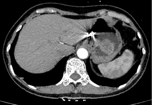 “饿死”大肿瘤、巧手建“隧道”,双微创技术牛!(图4) 4.jpg