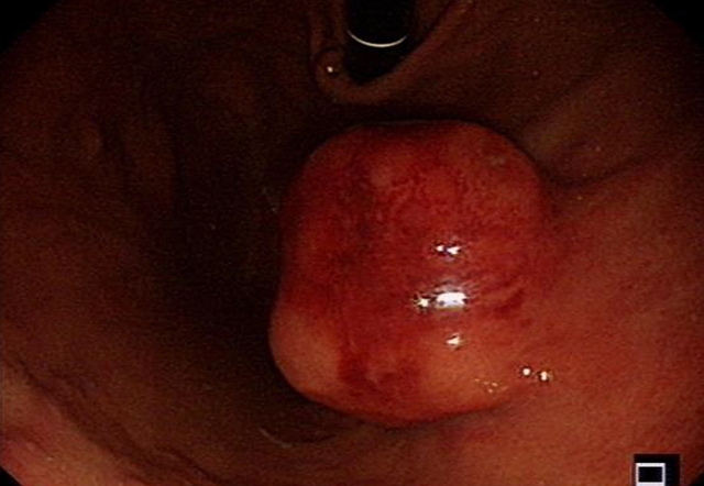 “饿死”大肿瘤、巧手建“隧道”,双微创技术牛!(图5) 5.jpg