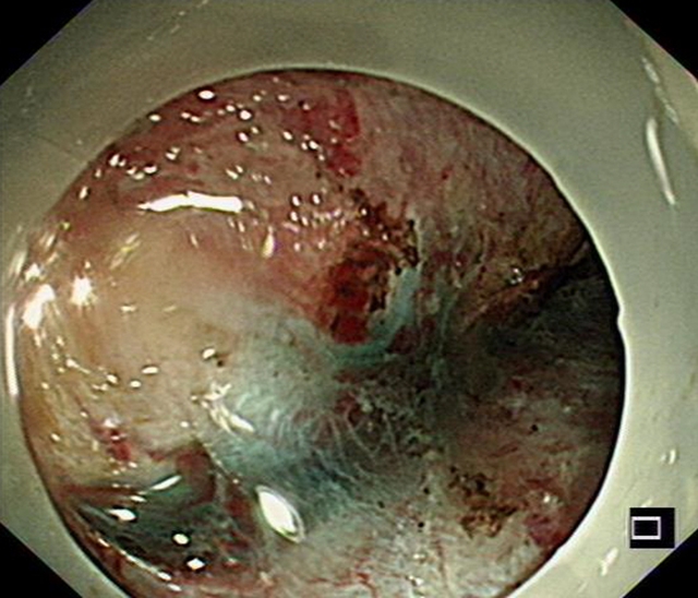 “饿死”大肿瘤、巧手建“隧道”,双微创技术牛!(图7) 7.jpg