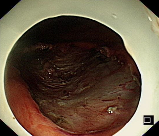 “饿死”大肿瘤、巧手建“隧道”,双微创技术牛!(图8) 8.jpg