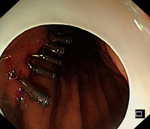 “饿死”大肿瘤、巧手建“隧道”,双微创技术牛!(图9) 9.jpg