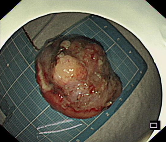 “饿死”大肿瘤、巧手建“隧道”,双微创技术牛!(图10) 10.jpg