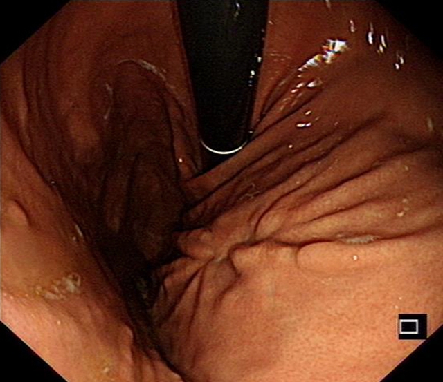 “饿死”大肿瘤、巧手建“隧道”,双微创技术牛!(图11) 11.jpg