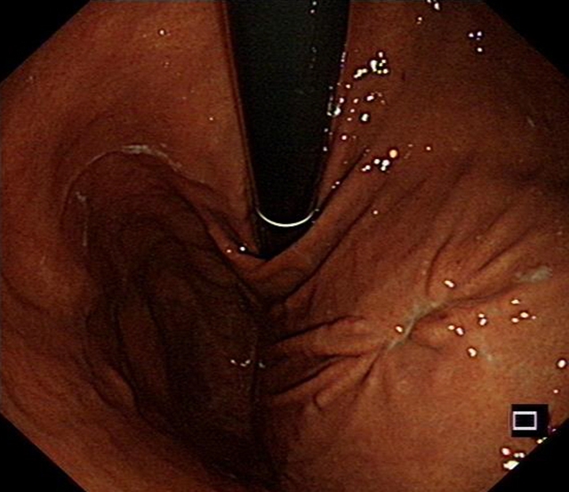 “饿死”大肿瘤、巧手建“隧道”,双微创技术牛!(图12) 12.jpg