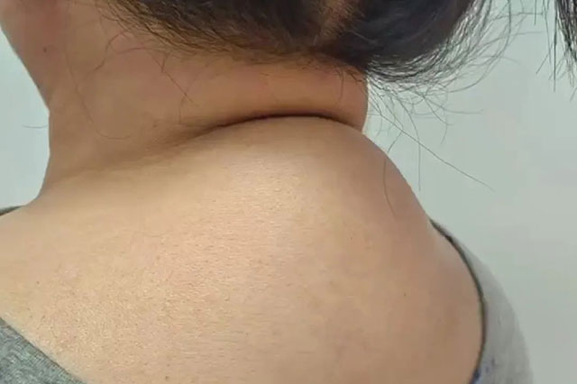 【关注】脖子上打2个小孔,轻松治愈大包!(图2) 2.jpg