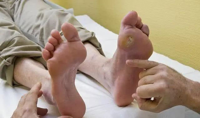 【警惕】一旦出现这些情况……就只能截肢？