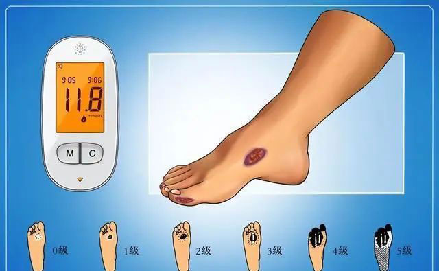 【警惕】一旦出现这些情况……就只能截肢?(图4) 5.jpg