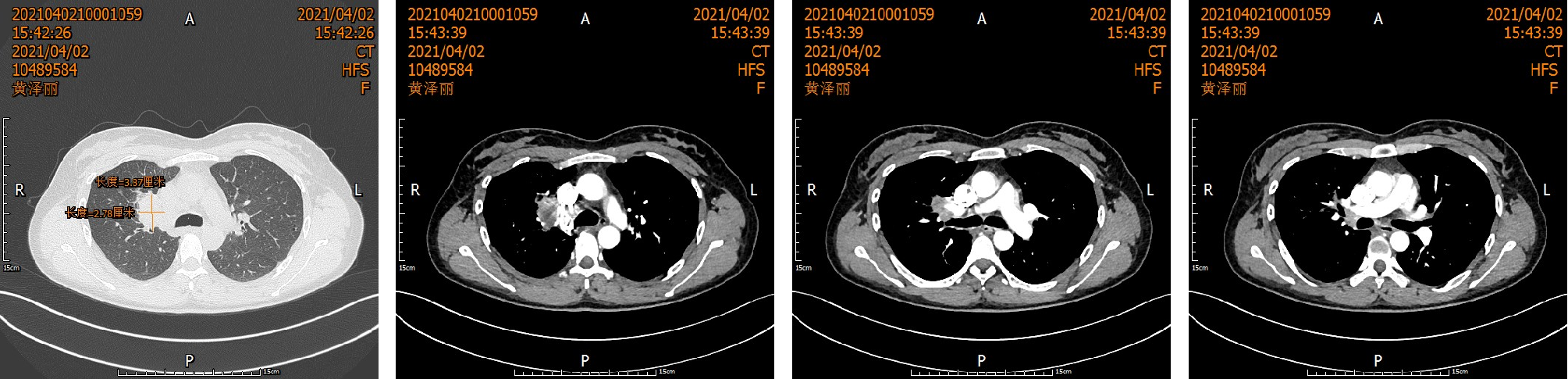 【奇迹】肺癌，从晚期到根治