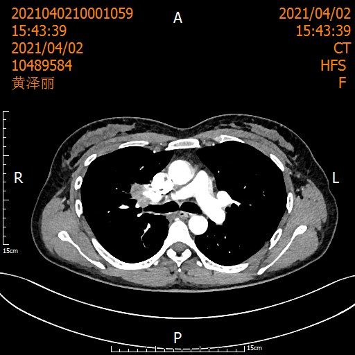 【奇迹】肺癌,从晚期到根治(图2) 2.png