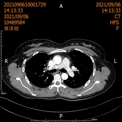 【奇迹】肺癌,从晚期到根治(图5) 5.png