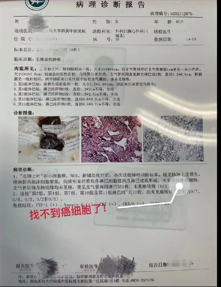 【奇迹】肺癌,从晚期到根治(图6) 6.jpg