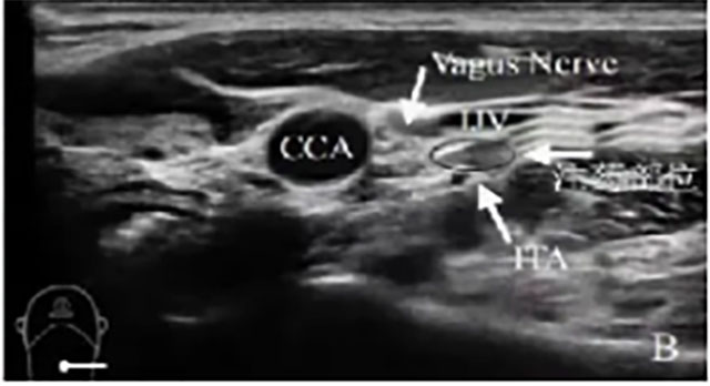 合江县中医医院睡眠科开科 | 中西医协同,专治“睡不着、睡不好”!(图8) 8.jpg