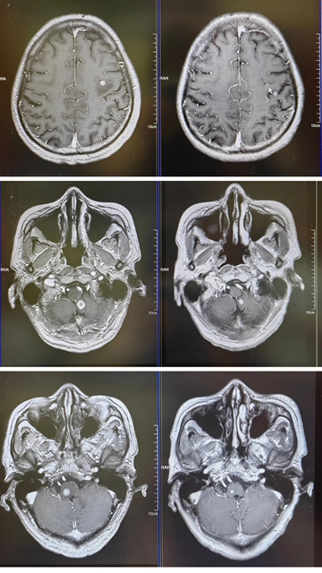 肺癌术后52天,头部长出3颗肿瘤(图4) 4.jpg