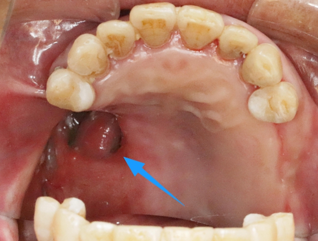 【关注】牙龈癌术后嘴巴出现黑洞，她靠“定制体”重生