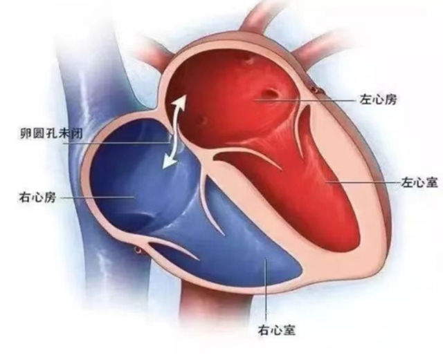 【扩散】20岁大学生长期偏头痛，竟然是心脏出问题了