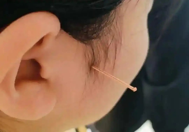 鼻炎老火?试试这个“鼻炎天下第一针”!(图2) 2.jpg