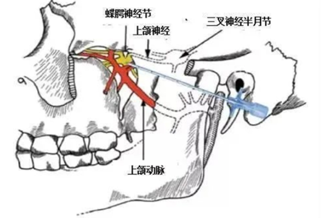 鼻炎老火?试试这个“鼻炎天下第一针”!(图3) 3.jpg