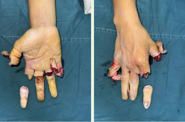小伙5根手指全部被切断……(图2) 6402.jpg