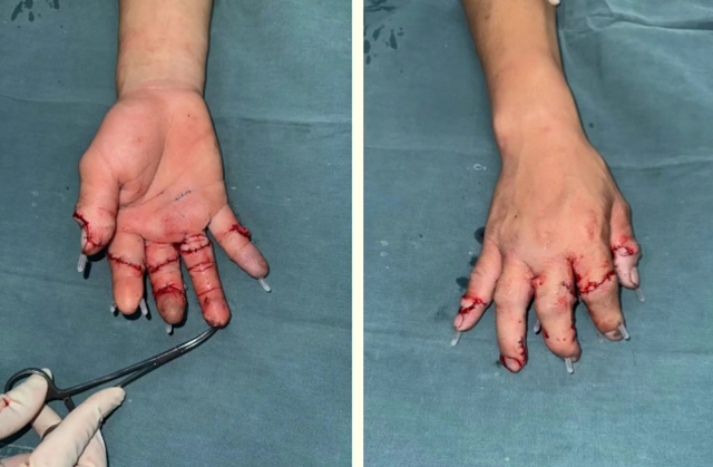 小伙5根手指全部被切断……(图3) 6403.jpg