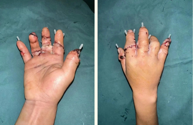 小伙5根手指全部被切断……(图4) 6404.jpg