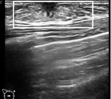 关于女童性早熟,超声医生有话说→(图7) 8.png