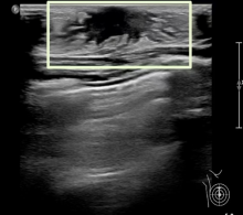 关于女童性早熟,超声医生有话说→(图6) 7.png