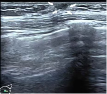 关于女童性早熟,超声医生有话说→(图5) 6.png