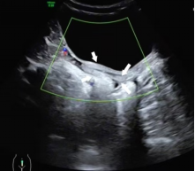 关于女童性早熟,超声医生有话说→(图9) 10.png