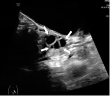 关于女童性早熟,超声医生有话说→(图12) 13.png