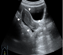 关于女童性早熟,超声医生有话说→(图11) 12.png
