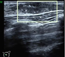 关于女童性早熟,超声医生有话说→(图8) 9.png