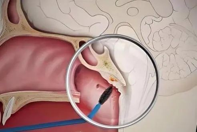 鼻咽癌,临床治愈!(图1) 工1.jpg