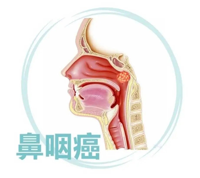 鼻咽癌,临床治愈!(图2) 工2.jpg