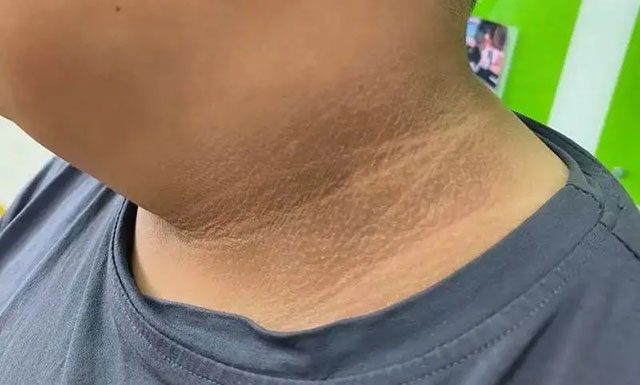 脖子黑得像没洗干净?别大意,这可能是求救信号!(图2) 2.jpg