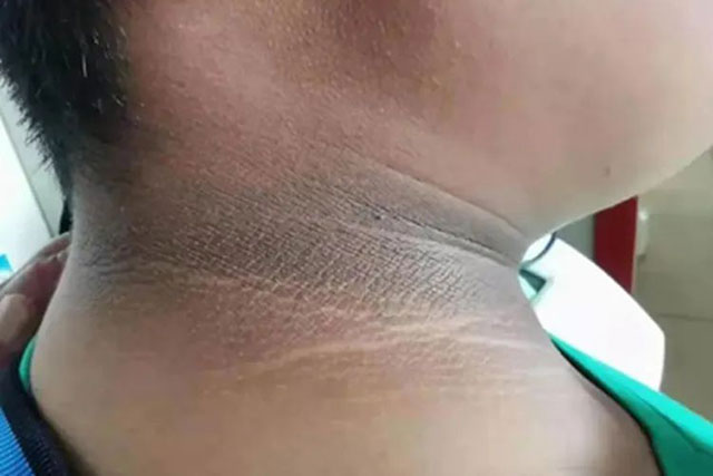 脖子黑得像没洗干净?别大意,这可能是求救信号!(图3) 3.jpg