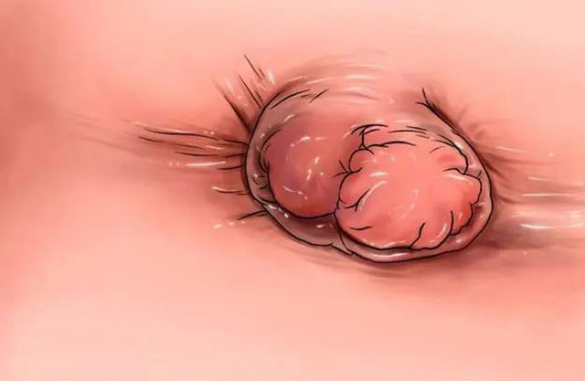 高中生上厕所,肠子“掉”了出来……(图4) 4.jpg