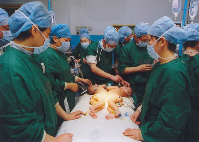 用爱心浇灌的两对连体“姐妹花”,长大后选择“医”路追随~(图5) 5.jpg