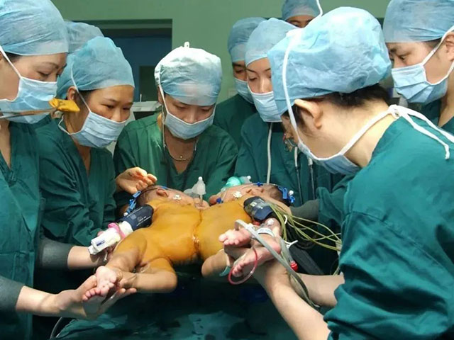 用爱心浇灌的两对连体“姐妹花”,长大后选择“医”路追随~(图16) 16.jpg