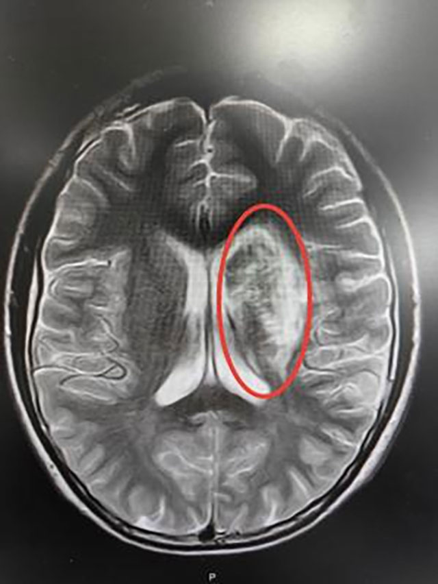 【警惕】12岁男孩脑梗死,原因竟是……(图1) 1.jpg