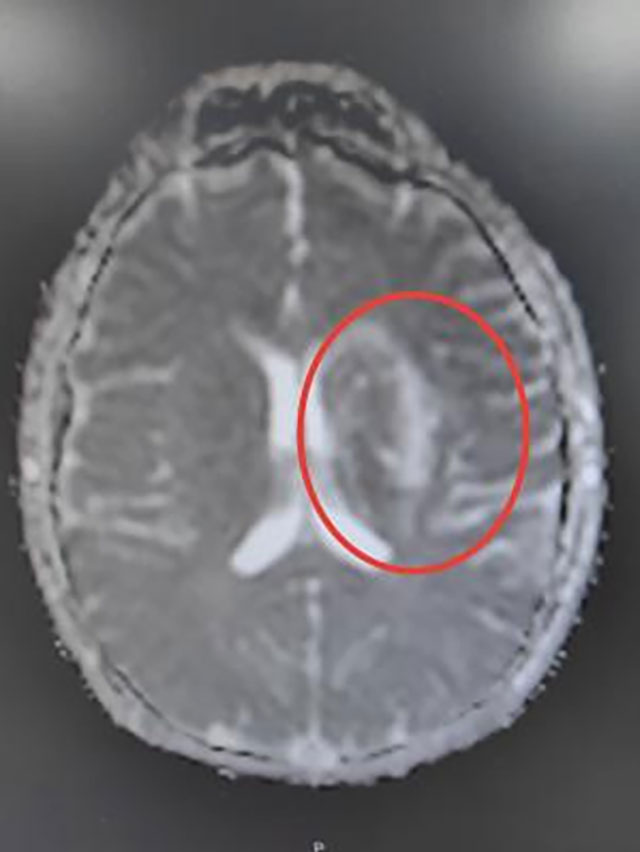 【警惕】12岁男孩脑梗死,原因竟是……(图4) 4.jpg