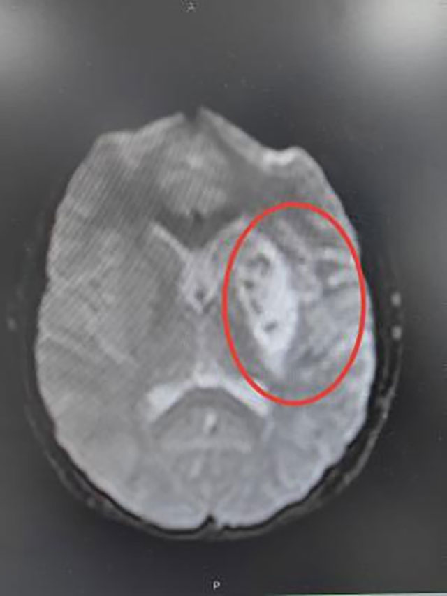 【警惕】12岁男孩脑梗死,原因竟是……(图3) 3.jpg