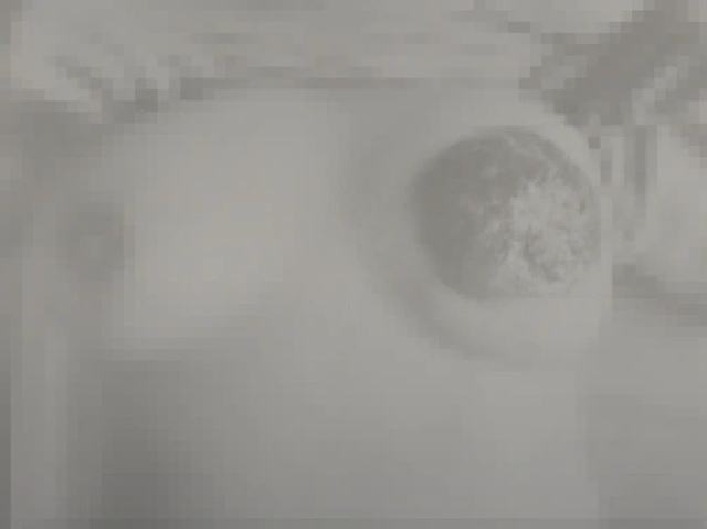 【一拖再拖】女子乳房大面积溃烂流脓,确诊乳腺癌!(图2) 乳2.jpg