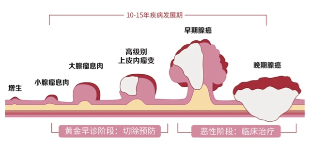 肠癌当痔疮!大便出现这些变化要当心......(图4) 6404.jpg